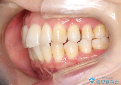 再矯正をインビザラインで目立たず手軽にの治療前