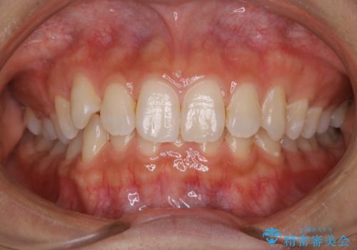 矯正を始める前に歯のクリーニングの治療後