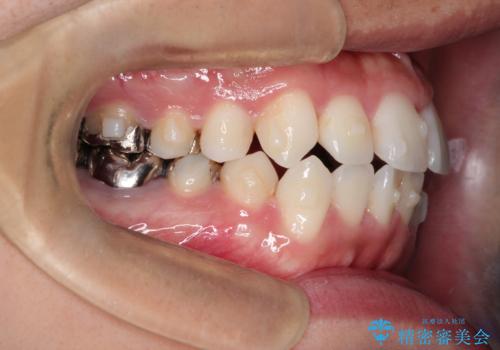 インビザラインで目立たない矯正 ガタガタの歯並びをきれいな歯並びへの治療中