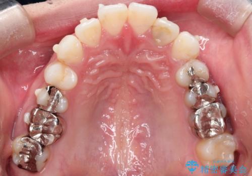インビザラインで目立たない矯正　ガタガタの歯並びをきれいな歯並びへの治療中