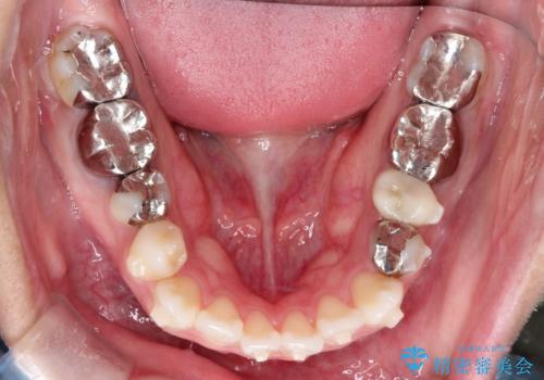 インビザラインで目立たない矯正 ガタガタの歯並びをきれいな歯並びへの治療中