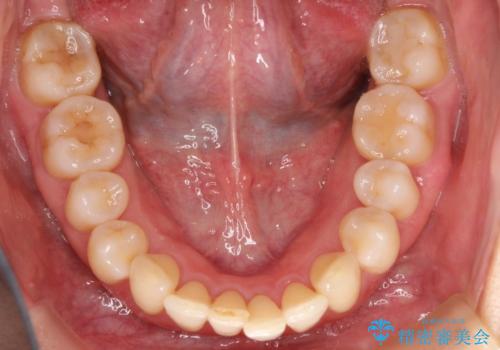 再矯正をインビザラインで目立たず手軽にの治療前