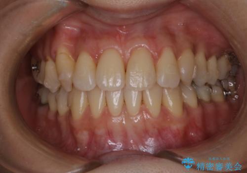 歯列矯正(インビザライン)中に着色を綺麗にクリーニングの治療後