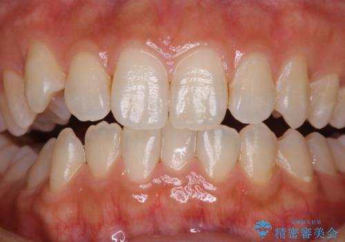 矯正を始める前に歯のクリーニングの症例 治療後