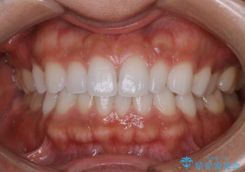 歯のメンテナンスの治療前