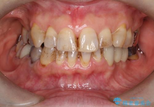 エアーフローでお茶による着色を除去の治療前