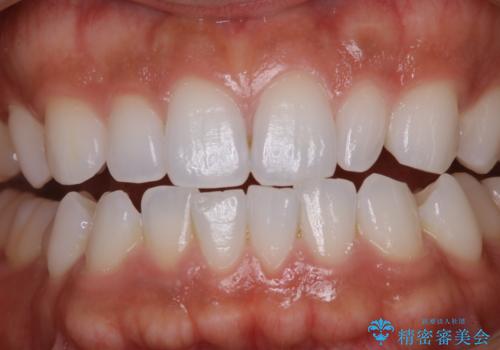 歯のメンテナンスの治療前