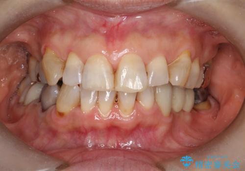オフィスホワイトニング スペシャルコースの治療前