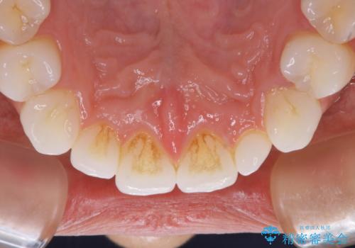 歯のメンテナンスの治療前