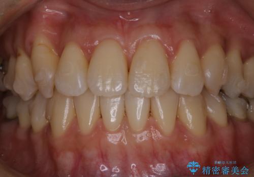歯列矯正(インビザライン)中に着色を綺麗にクリーニングの治療後
