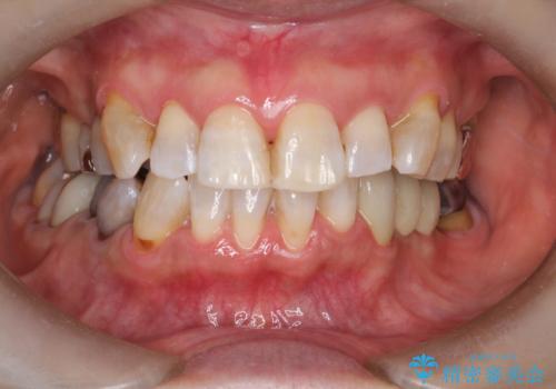 オフィスホワイトニング スペシャルコースの治療後