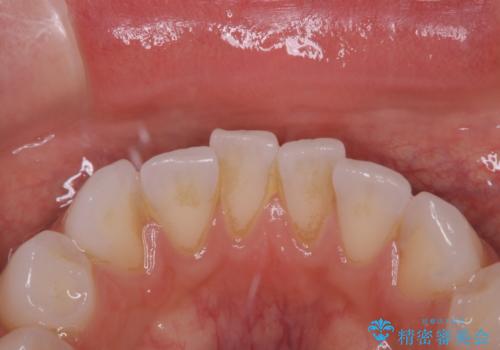 歯のメンテナンスの治療前