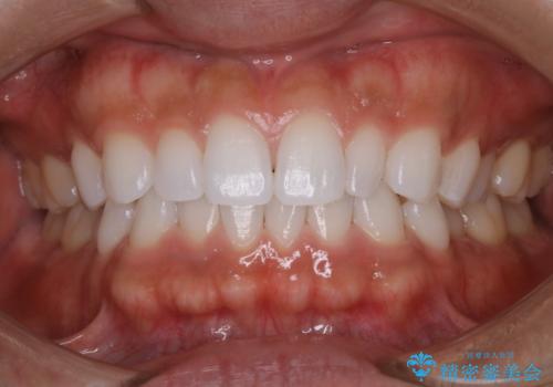 歯のメンテナンスの治療後
