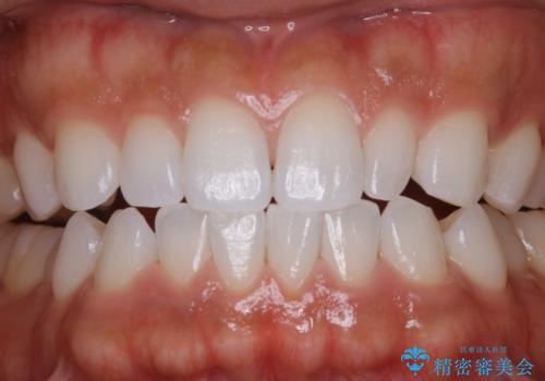 歯のメンテナンスの治療後