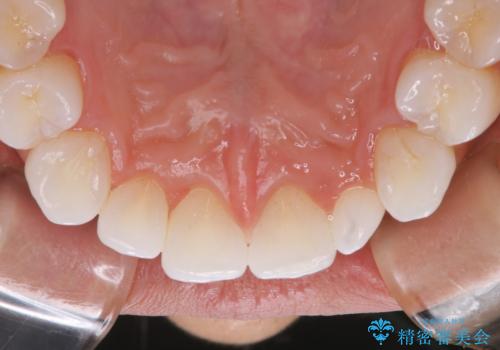 歯のメンテナンスの治療後