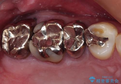 放置して悪化してしまったむし歯を早めに対応 セラミッククラウンによるむし歯治療の症例 治療前