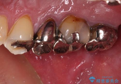 放置して悪化してしまったむし歯を早めに対応 セラミッククラウンによるむし歯治療の治療前