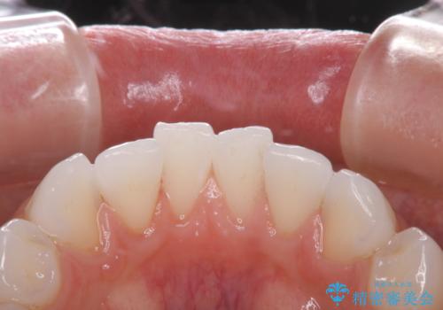 歯のメンテナンスの治療後