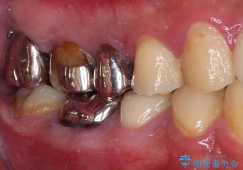 放置して悪化してしまったむし歯を早めに対応 セラミッククラウンによるむし歯治療の治療前
