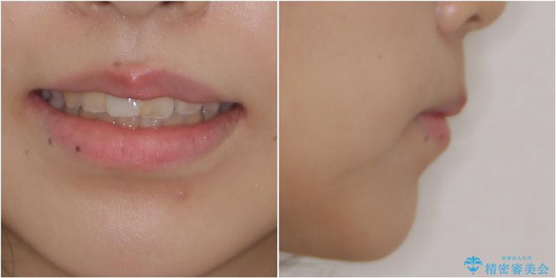 怪我をして不格好な前歯　矯正治療とインプラント補綴治療の治療後（顔貌）