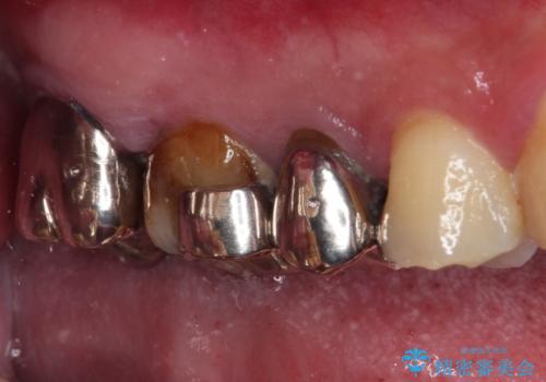 放置して悪化してしまったむし歯を早めに対応 セラミッククラウンによるむし歯治療の治療前