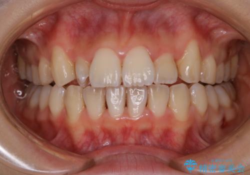 矯正中のPMTC60分コースの治療前