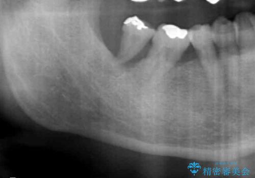 60代男性 奥歯のブリッジ 倒れこんでいる奥歯を部分矯正の治療前
