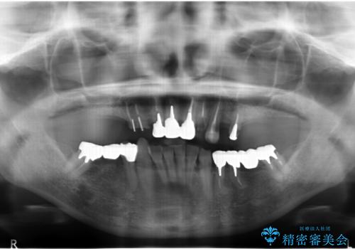 多発した虫歯による咬合崩壊    インプラントを用いた全顎治療の治療前