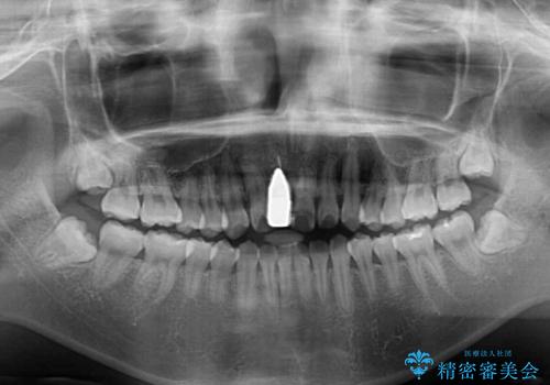 怪我をして不格好な前歯 矯正治療とインプラント補綴治療の治療前