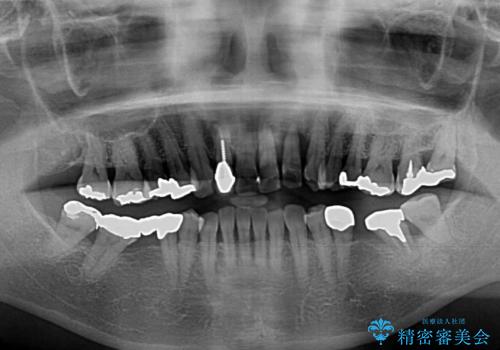 気になる所を一気に治療 総合歯科治療の治療前