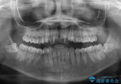 目立つ八重歯を目立たない装置で ハーフリンガルによる抜歯矯正の治療前