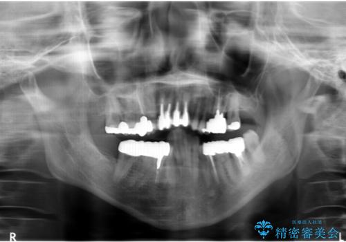 矯正治療とセラミック治療で口腔内環境を劇的に改善の治療前