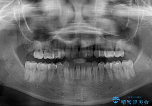 目立つ八重歯を目立たない装置で ハーフリンガルによる抜歯矯正の治療後