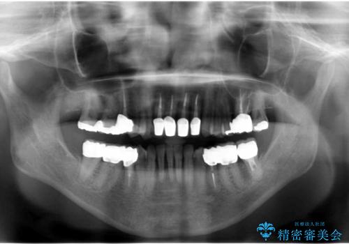 矯正治療とセラミック治療で口腔内環境を劇的に改善の治療後