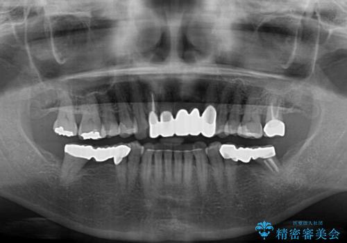気になる所を一気に治療 総合歯科治療の治療後