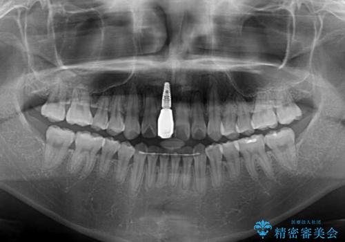 怪我をして不格好な前歯 矯正治療とインプラント補綴治療の治療後