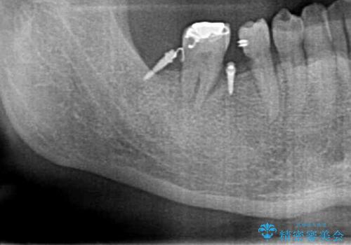 60代男性　奥歯のブリッジ　倒れこんでいる奥歯を部分矯正の治療中
