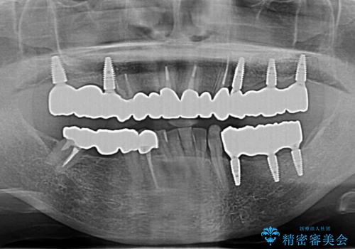 多発した虫歯による咬合崩壊    インプラントを用いた全顎治療の治療後