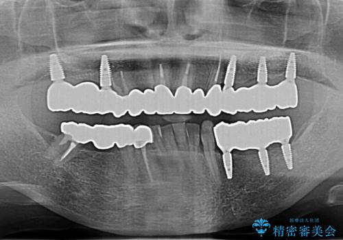 多発した虫歯による咬合崩壊    インプラントを用いた全顎治療