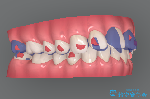 マウスピース 狭窄歯列の改善