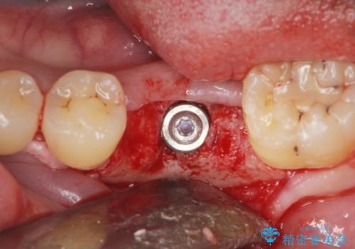 インプラントによる咬合機能回復の治療中