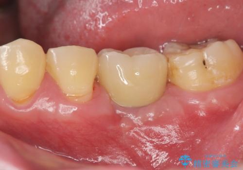 インプラントによる咬合機能回復の症例 治療後