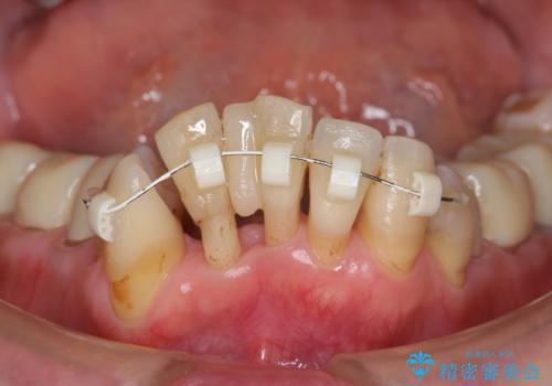 矯正治療とセラミック治療で口腔内環境を劇的に改善の治療前