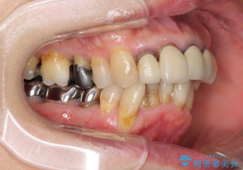 矯正治療とセラミック治療で口腔内環境を劇的に改善の治療前
