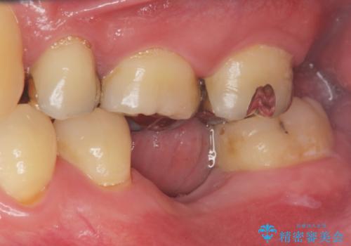 インプラントによる咬合機能回復の治療前