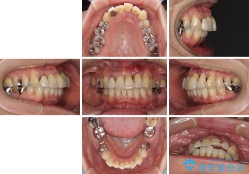 気になる所を一気に治療 総合歯科治療の治療前