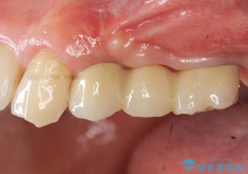 インプラント治療で達成する奥歯のしっかりとした咬合の症例 治療後