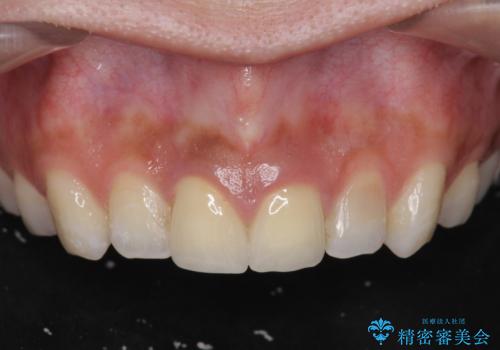 [ セラミック治療  ]   前歯を自然にしたい、セラミッククラウンのやりかえの症例 治療後