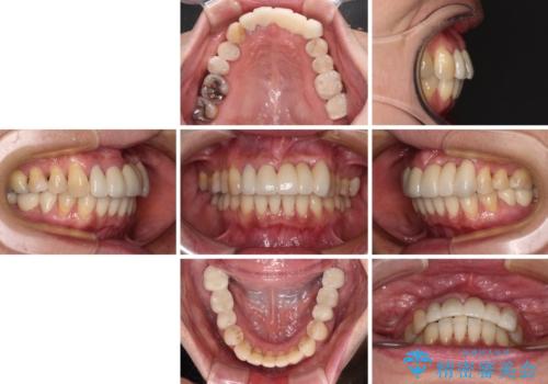 気になる所を一気に治療 総合歯科治療の治療後