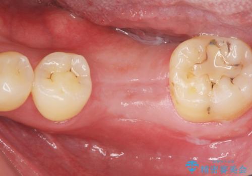 インプラントによる咬合機能回復の治療中